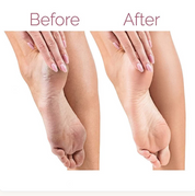 Electric Foot File Callus Remover